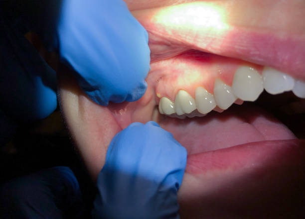 Best Emergency Dental Care for Broken or Chipped Teeth in Ruston, LA